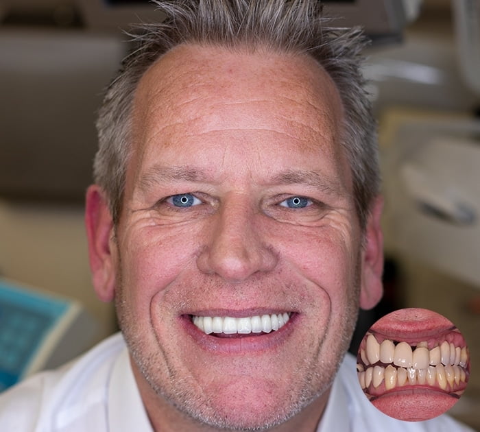 After having Loose Denture solutions treatment