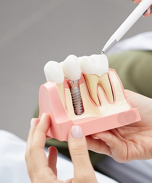 dental implants Birmingham