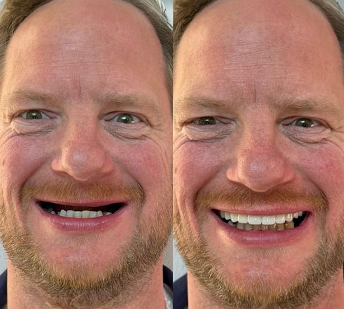 before-after-at-dental-implant-centre